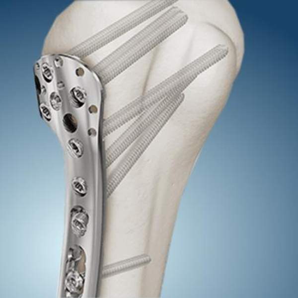 Блокированный накостный остеосинтез ООО "Титанмед"