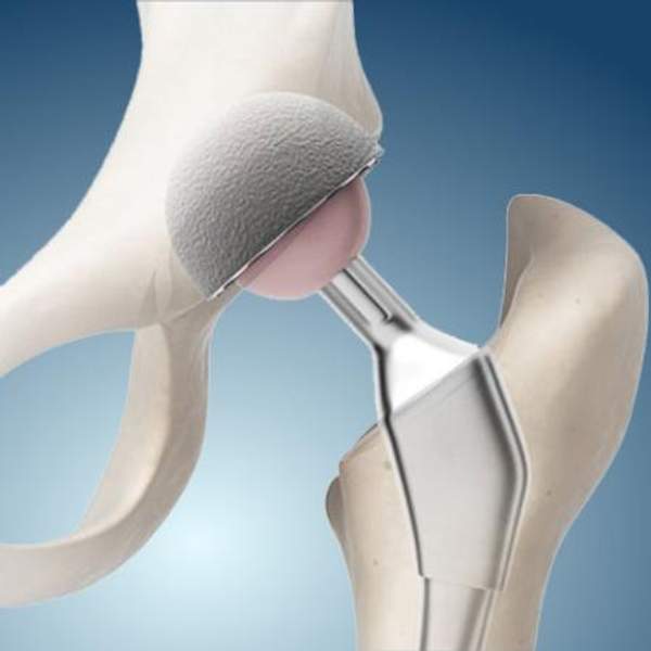 Эндопротезы ООО "Титанмед"