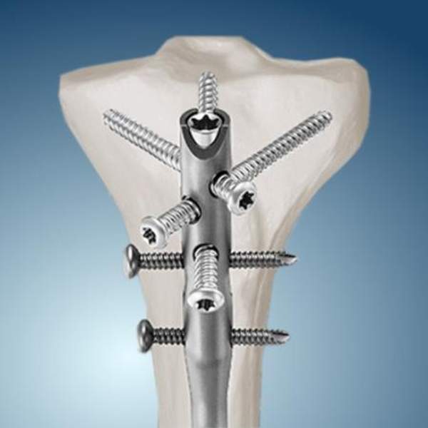 ?нтрамедуллярный остеосинтез ООО "Титанмед"