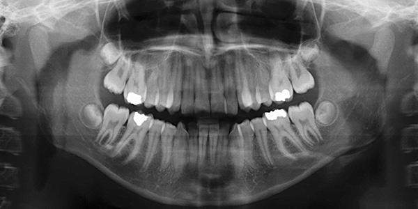 Ортопантомограмма зубов