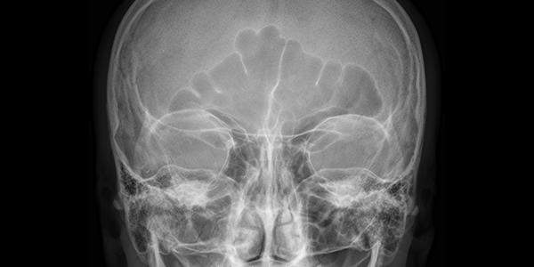 Рентген пазух носа