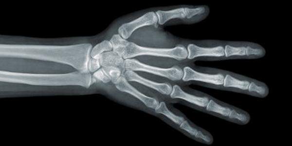 Рентгенограмма кисти руки