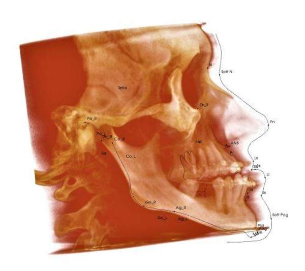 Цефалометрический анализ