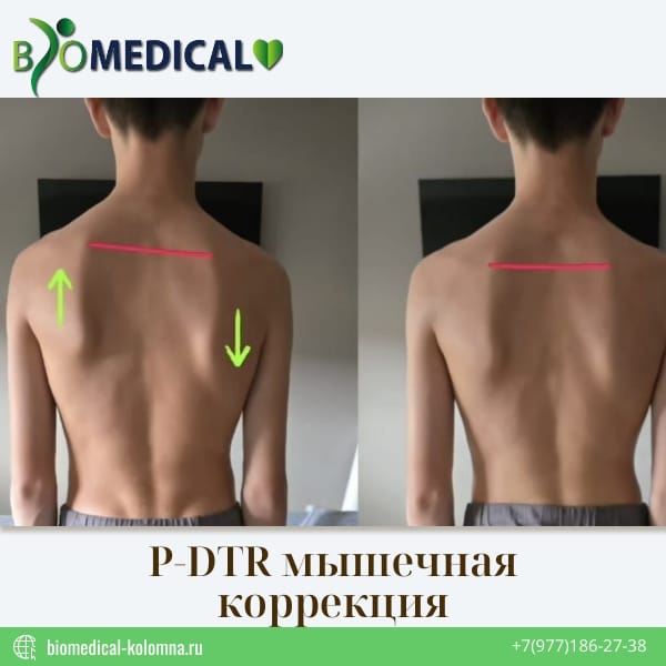 P-DTR мышечная коррекция