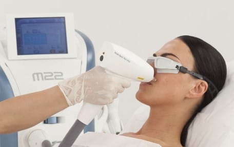 Удаление пигментных пятен на лице