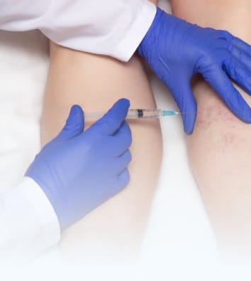 Склеротерапия вен