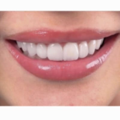 Керамические виниры высочайшего качества.