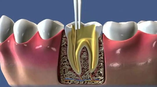 Лечение пульпита