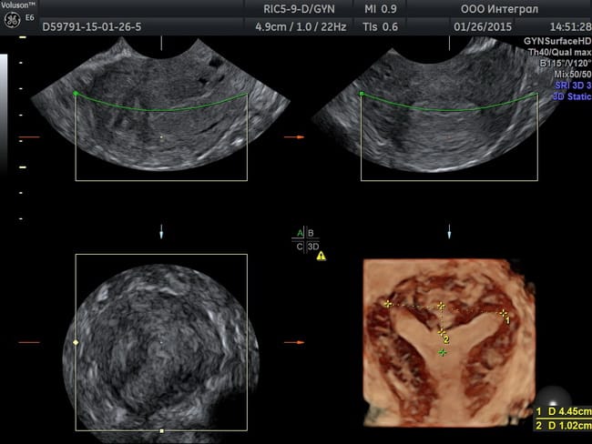 Гинекологическое узи